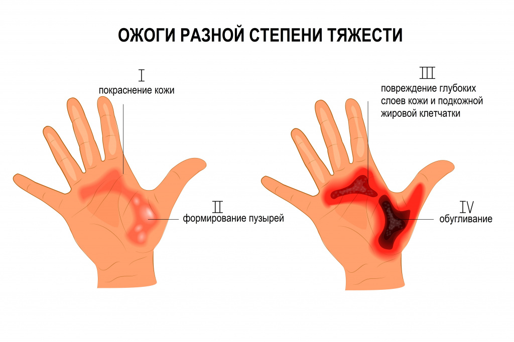 ЭПЛАН для лечения ожогов